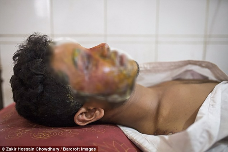 Từ chối lời tỏ tình của bạn gái 16 tuổi, nam thanh niên bị tạt axit tới biến dạng gương mặt